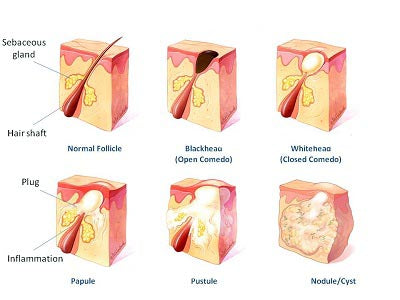 acne treatment mistakes
