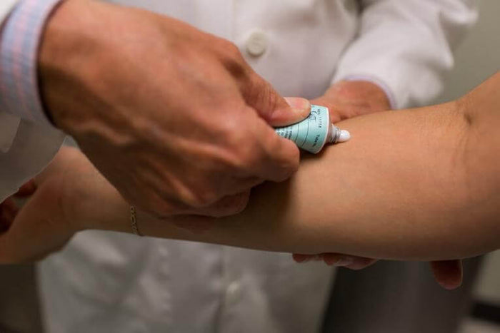 eczema treatment