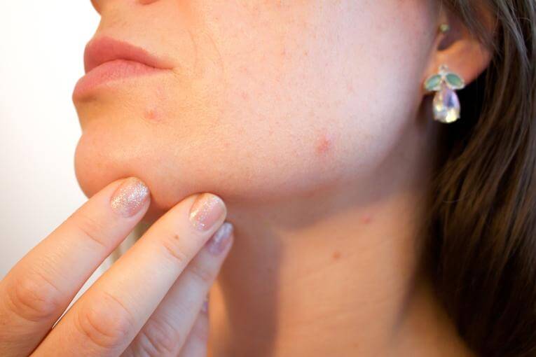 acne scarring treatment