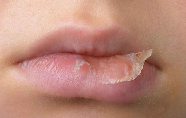 lip eczema