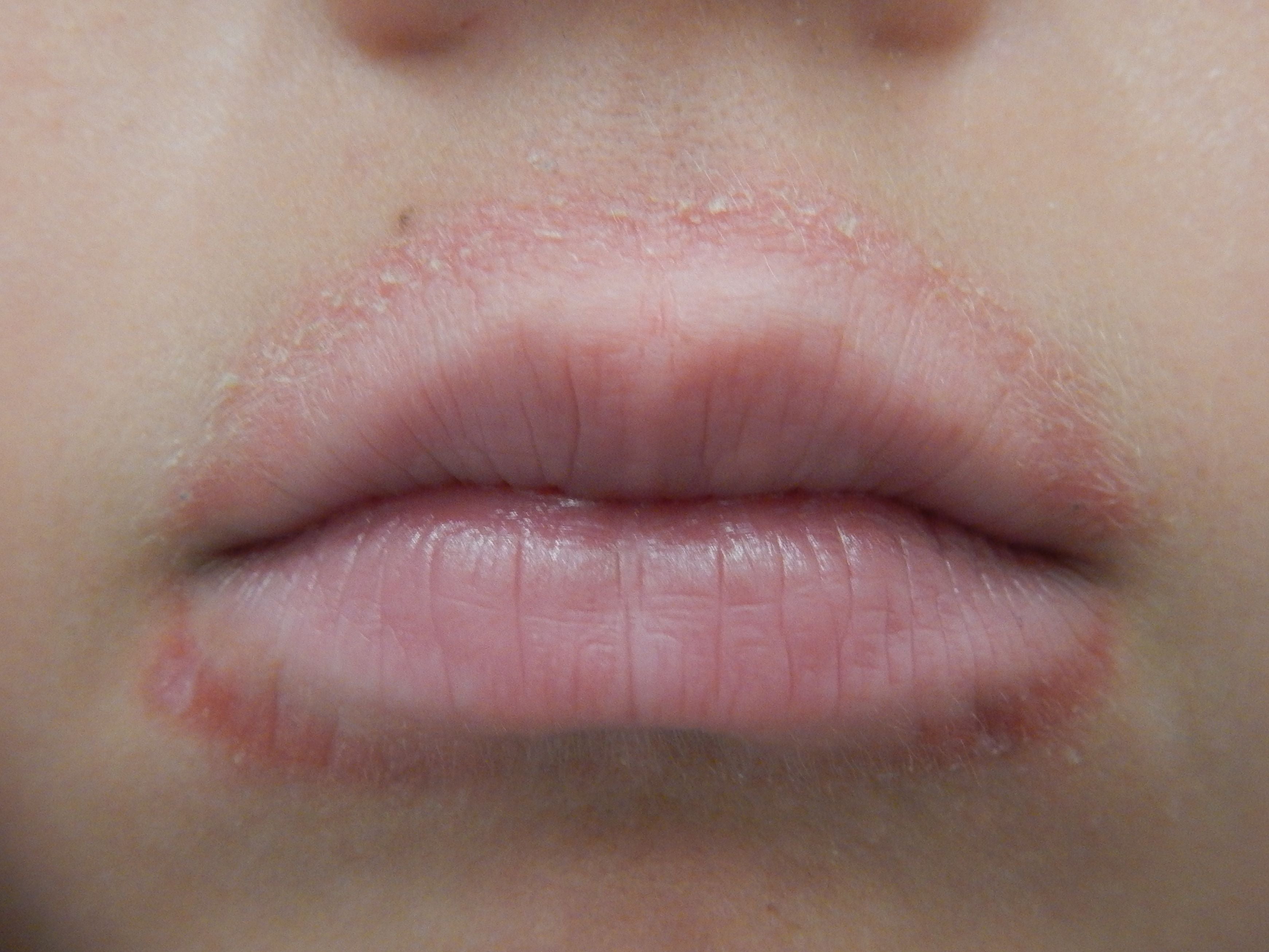 Childhood Lip Eczema