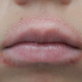 childhood lip eczema dermatitis 