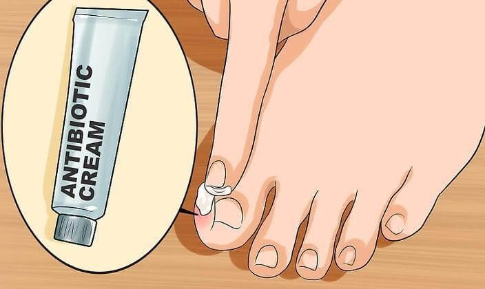 ingrown toenail treatment