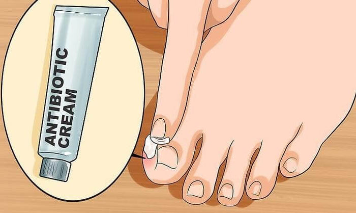 ingrown toenail treatment