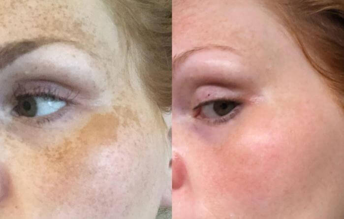 nontoxic healing of melasma