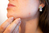 acne scarring treatment 