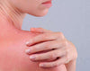 heal sunburn skin