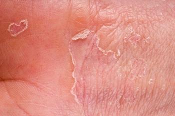 Living With Eczema: No Prescription Required