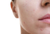 hormone triggered acne