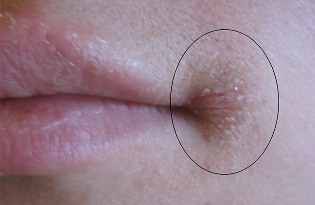 Angular Cheilitis